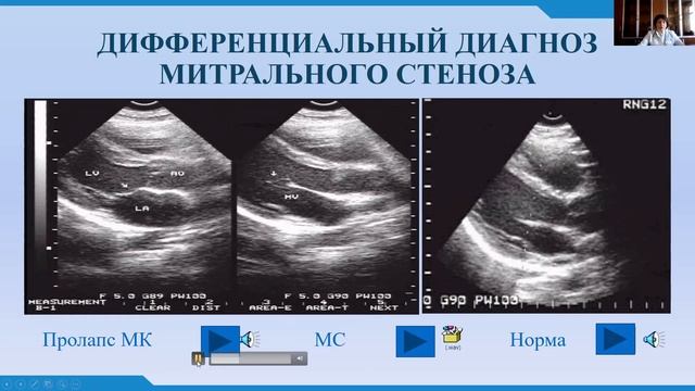 ДИФФЕРЕНЦИАЛЬНАЯ ДИАГНОСТИКА ШУМОВ СЕРДЦА НЕДОСТАТОЧНОСТЬ МИТРАЛЬНОГО КЛАПАНА,