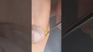 Удаление пяточной мозоли