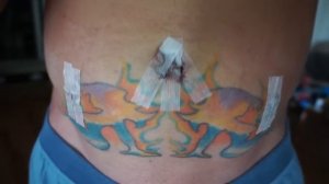 Hernia Surgery Recovery First Week - What to expect