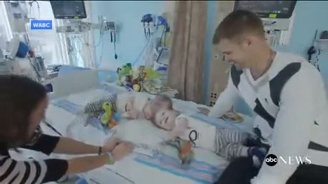 Twins Joined at the Chest Successfully Separated in 18-Hour Surgery смотреть онлайн
