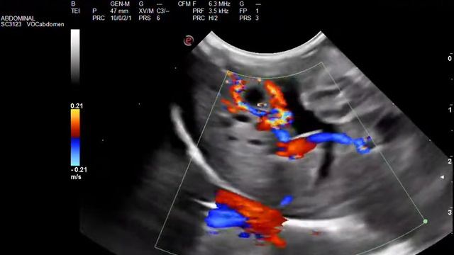 Fistula arterio venosa Doppler color 1 смотреть онлайн