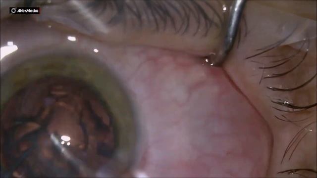 Carusel technique in soft cataract, Sifi Mini Well IOL by Adrian Gavanescu