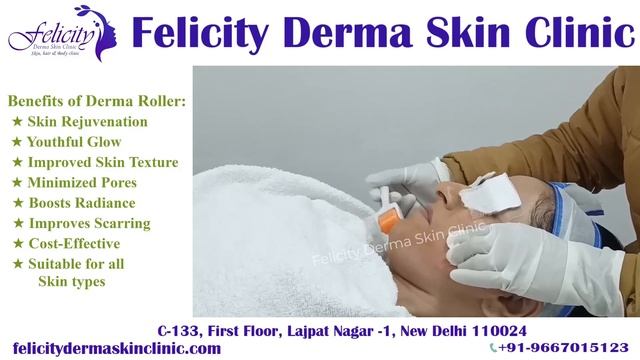 Derma Roller Treatment, Revitalize, Rejuvenate, Renew Yourself for Flawless Skin