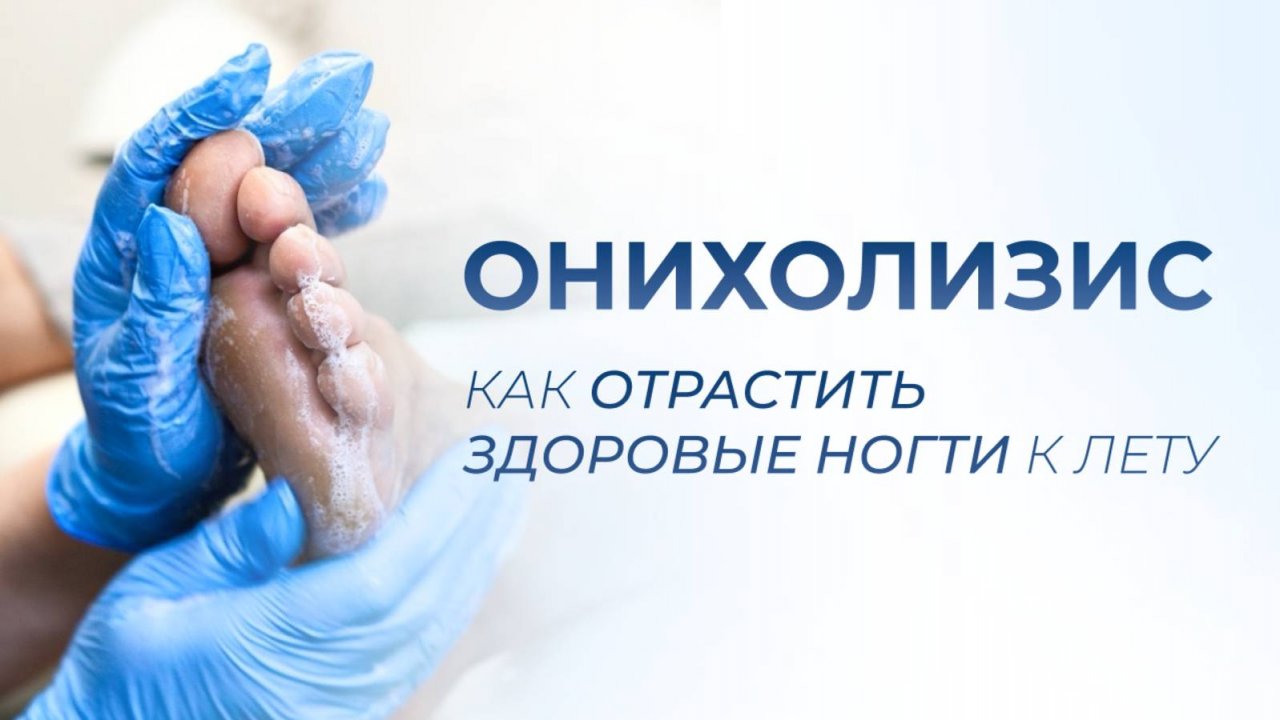 Онихолизис. Как отрастить здоровые ногти к лету?
