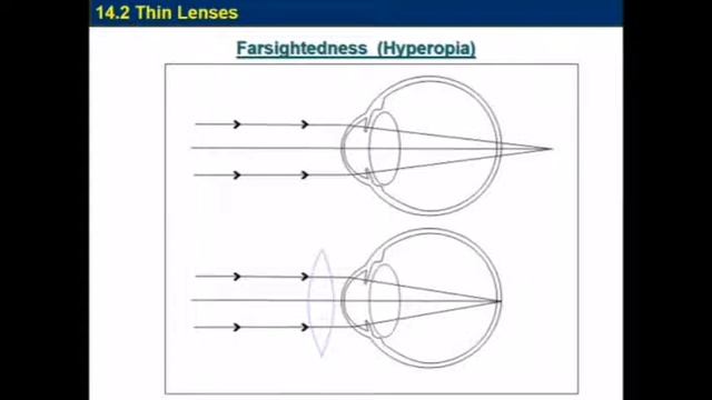 Physics,, Myopia and hyperopia смотреть онлайн