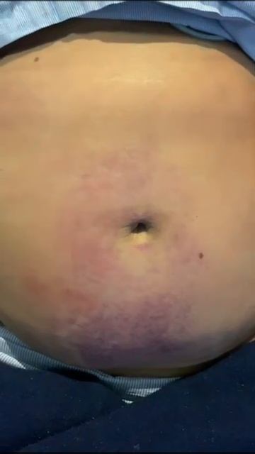 Cullen's SIgn :Retroperitoneal Hemorrhage, in Acute Hemorrhagic Pancreatitis смотреть онлайн