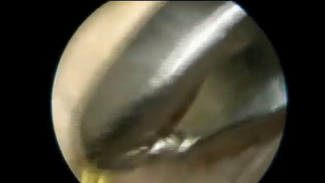 Трансляция хирургической техники на плечевом суставе от Эдуарда Рахманкулова. Артромастер 2024 смотреть онлайн