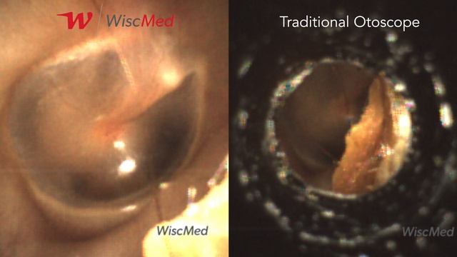The Wispr Digital Otoscope compared to a Traditional Otoscope смотреть онлайн
