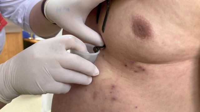 Гирудотерапия при сердечно-сосудистых заболеваниях🫀 смотреть онлайн