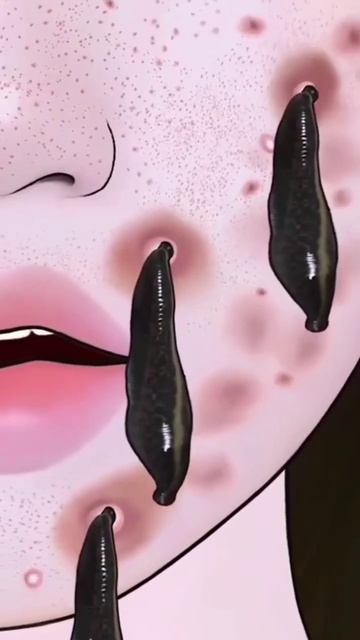 🧖#Leech#acnetreatment #Skincare #videos #makeup videos #acne #removal | #ASMR videos ASMR #skincare
