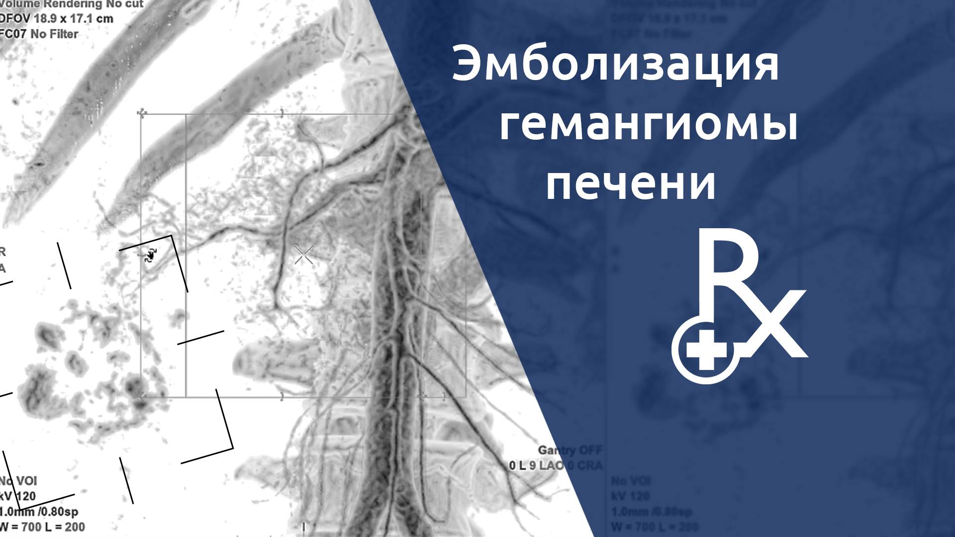 Эмболизация гемангиомы печени