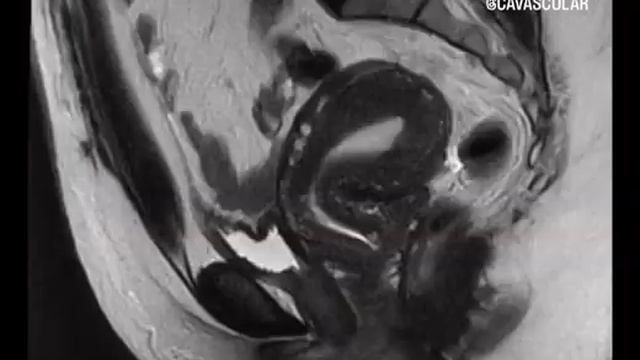 MRI before and 6 months after uterine fibroid embolization UFE - center top doctor - results смотреть онлайн