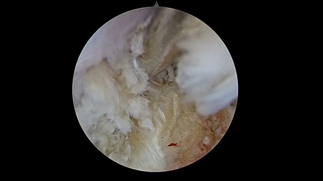 Грыжа L4 диска контралатерально смотреть онлайн