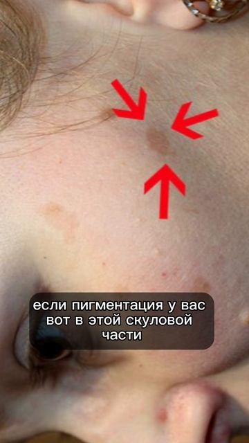 причины появления пигментации #пигментныепятна #похудение #пп #нутрициолог #стресс #потерявеса