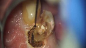 Коагуляція ясен, діатермокоагулятор ДКС-30