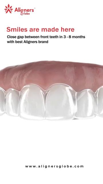 Best treatment for upper front teeth Gap |  Midline Diastema Closure | Aligners Globe