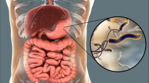 Замучали ГАЗЫ и ВЗДУТИЕ! Жаль не знал раньше об ЭТОМ! Метеоризм - причины, последствия и лечение.