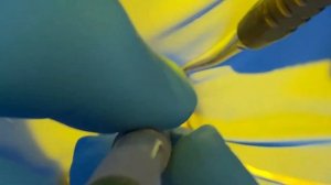 Calset Warmed Composite Cementation Procedure by Dr. Matt Nejad   #addent