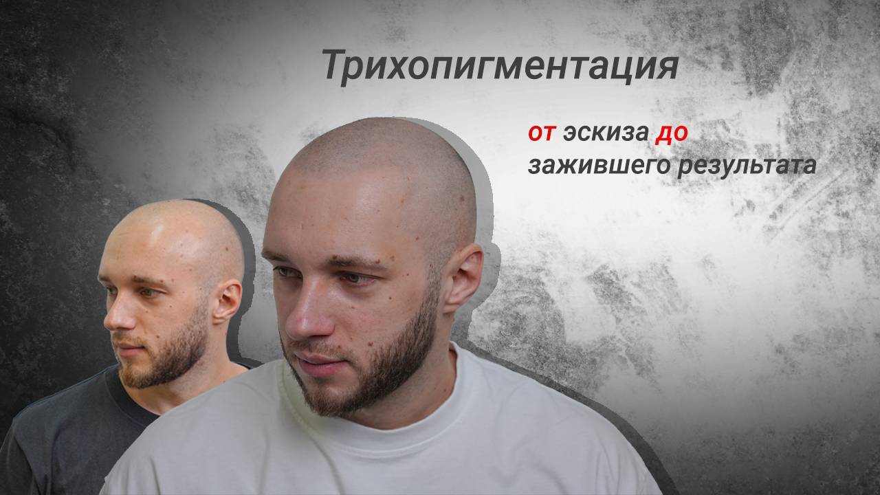 А тебе, лысый, я телефон дам (часть 1). Процесс трихопигментации  от эскиза до зажившего результата