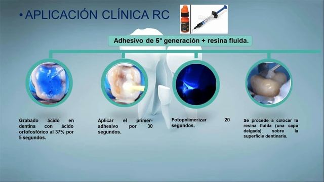 Sellado Adhesivo de la dentina - Sellado Dentinario Inmediato смотреть онлайн