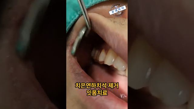 마취부터 시작하는 실제 잇몸치료 과정 #잇몸질환 #잇몸치료 #치주질환 #잇몸병 #치주염 #치과의사