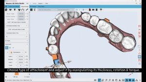 Maestro 3D | Dental Studio | User Video Tutorials | Come aggiungere un Ponte Virtuale