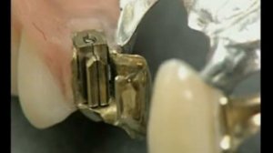 Протез с аттачменом