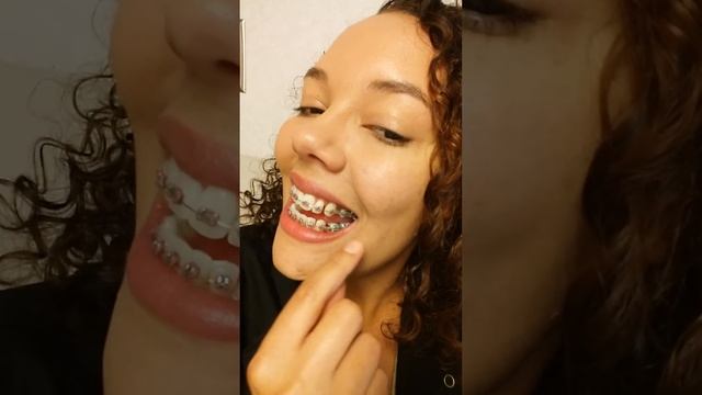 Adult braces 3 month update. .. Love the results смотреть онлайн