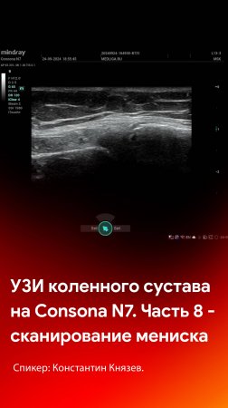 УЗИ коленного сустава на Mindray Consona N7. Часть 8 - сканирование медиального мениска