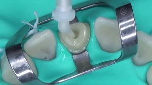 Post Cementation and Core Build-Up Using LuxaCore Z Dual