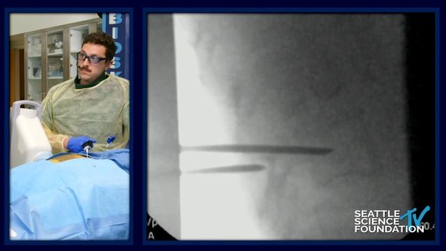 Cement Augmentation and Ablation for Spinal Tumors Kyphoplasty vs Vertebroplasty- Glen David, MD смотреть онлайн