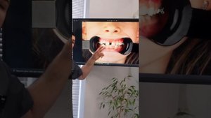 Скученность зубов у ребенка. Аппарат Марко-Роса