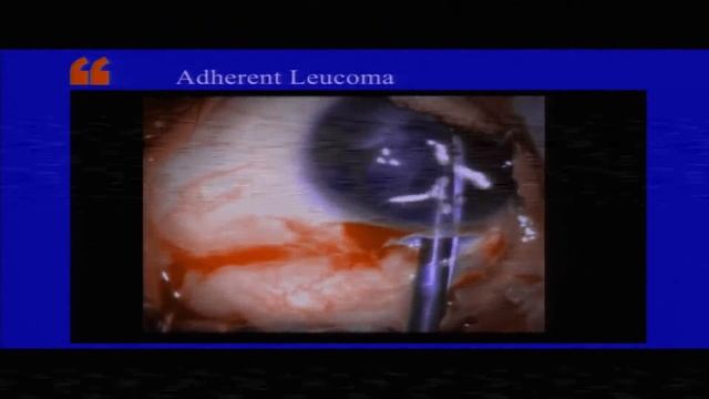 AIOC2018 - GP028 - Topic - Phaco in cataract and corneal opacity смотреть онлайн
