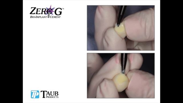Zero G Bio Implant Cement - Retrievable - Easy to See - Simple Removal of Excess Cement смотреть онлайн