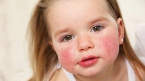 Как лечить аллергию у детей? Советы нутрициолога. Зарегистрироваться и получить подарок