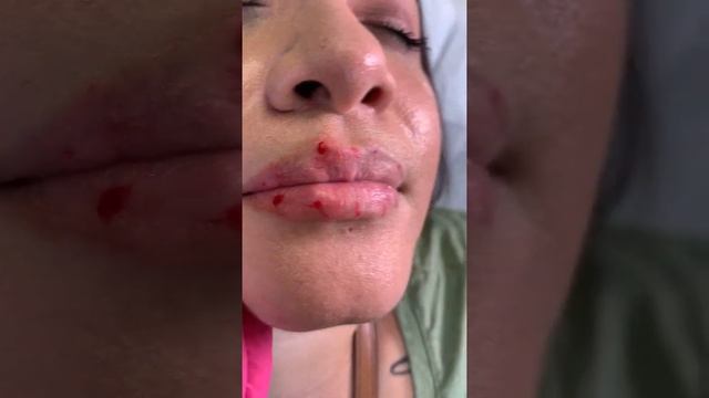 Lip Enhancement By Dr.Assif | O De Rose Med Spa смотреть онлайн