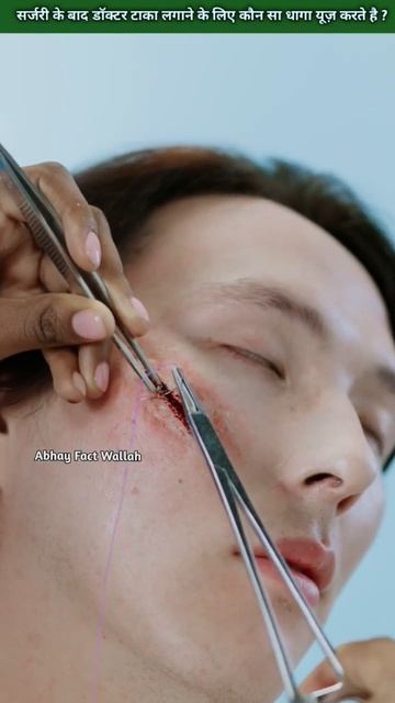 सर्जरी के बाद डॉक्टर टाका लगाने के लिए कौन सा धागा यूज़ करते है ? By Abhay Fact Wallah смотреть онлайн