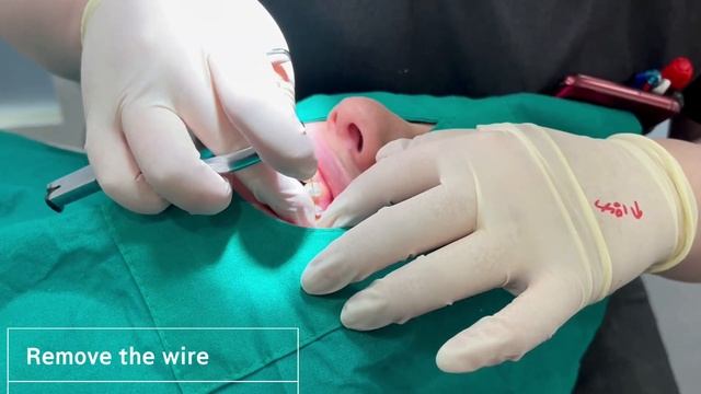 English Dentist_Braces Check up_bending orthodontic wire смотреть онлайн