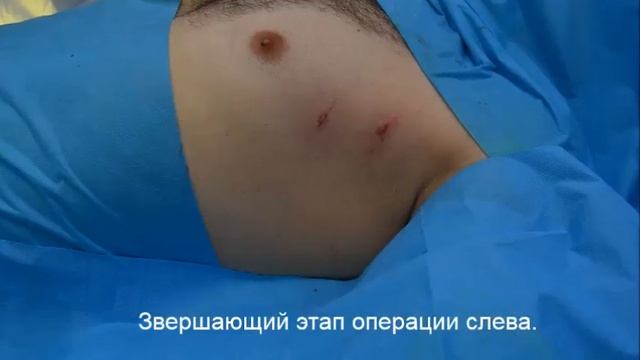 Лечение гипергидроза. Эндоскопическая симпатэктомия.