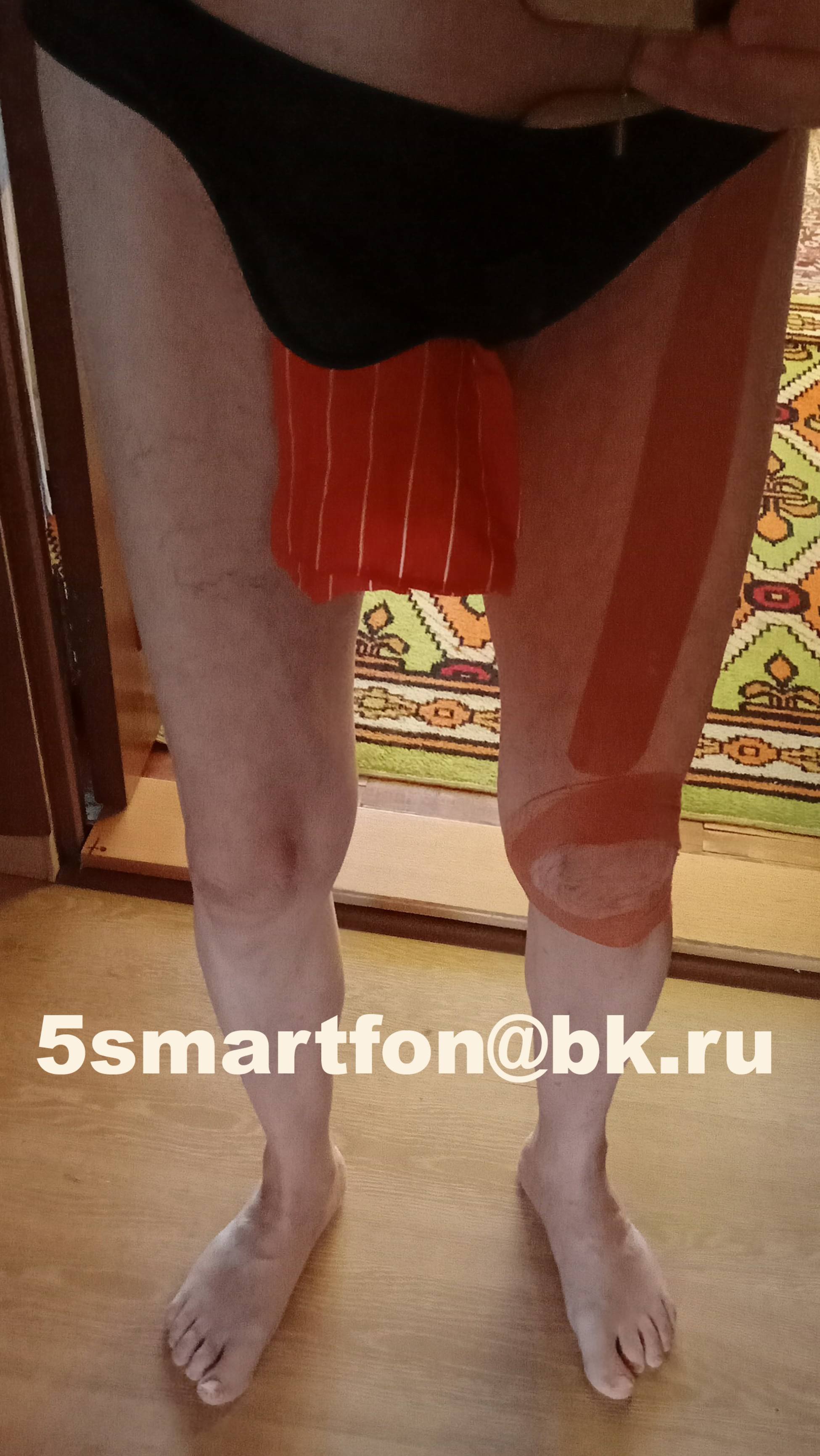 грыжа без операции