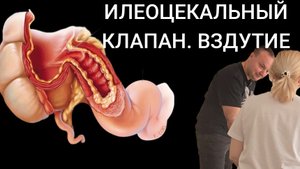 Илеоцекальный клапан. Вздутие живота.