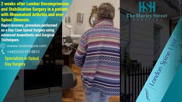 Spinal Stenosis with Rheumatoid Arthritis. Can you get both? смотреть онлайн