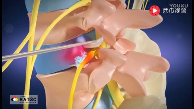 Иглонож при грыже в поясничном отделе позвоночника. Китайская медицина. Иглоукалывание смотреть онлайн