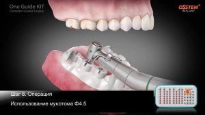 OSSTEM OneGuide