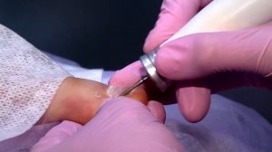 Установка коррекционной системы для коррекции вросшего ногтя.