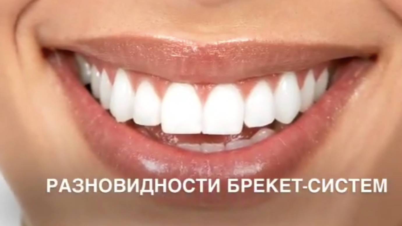 💥Виды брекетов: сравнение