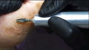 Гиперкератоз 😱⚠️🆘❗️🦶🏻