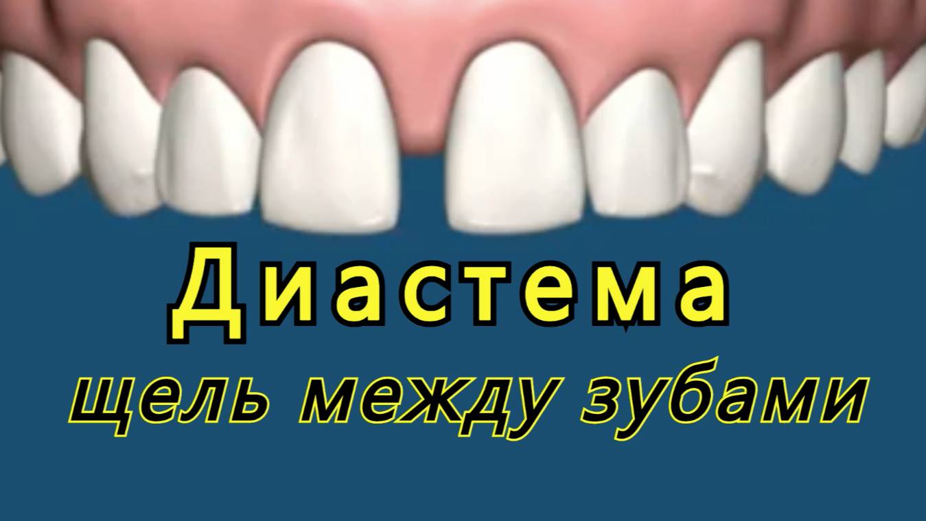 💥Диастема и многое другое