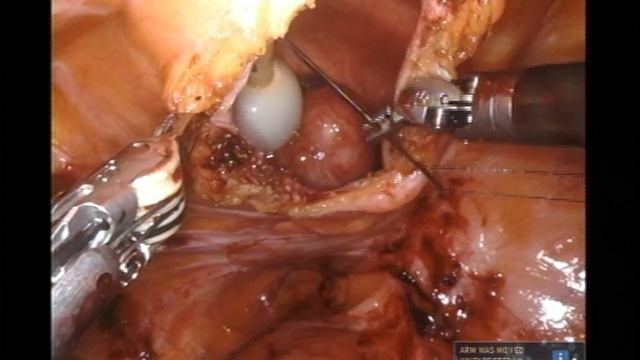 Robotic Simple Prostatectomy for BPH - Ketan K. Badani, MD - Mount Sinai Urology Department смотреть онлайн