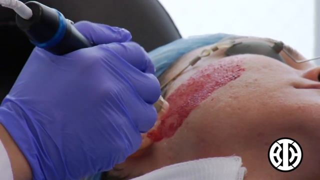 Platelet Rich Plasma (PRP) to stimulate collagen in the skin смотреть онлайн